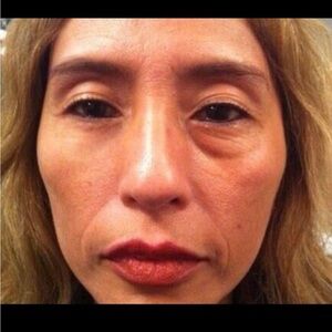 Dynamic Supreme Non Surgical Lifting Innovation Serum Puffiness Reducer Skincare